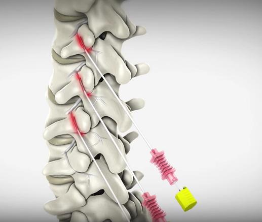 Cervical Facet Radiofrequency Neurotomy in St. George, Utah