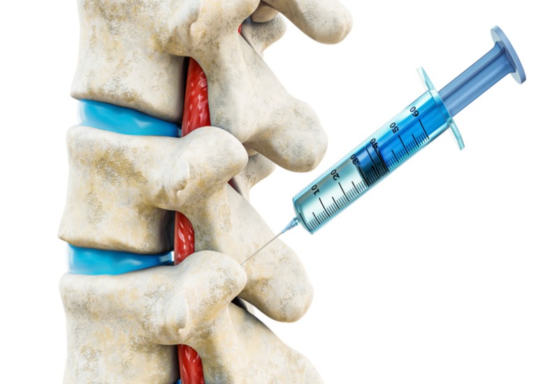 Epidural and Facet Injections in St. George, Utah