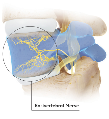 Medical Procedure called Intracept Treatment being performed in St. George, UT